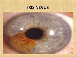 IRIS NEVUS
 