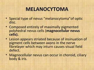 MELANOCYTOMA
• Special type of nevus “melanocytoma”of optic
  disc.
• Composed entirely of maximally pigmented
  polyhedral nevus cells (magnocellular nevus
  cells).
• Lesion appears striated because of insinuation of
  pigment cells between axons in the nerve
  fibrelayer which may inturn causes visual field
  defect.
• Magnocellular nevus can occur in choroid, ciliary
  body & iris.
 