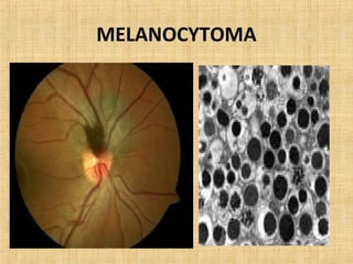 MELANOCYTOMA
 