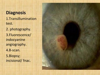 Diagnosis
1.Transillumination
test.
2. photography.
3.Fluorescence/
indocyanine
angiography.
4.B-scan.
5.Biopsy;
incisional/ fnac.
 