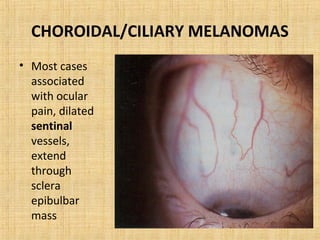 CHOROIDAL/CILIARY MELANOMAS
• Most cases
  associated
  with ocular
  pain, dilated
  sentinal
  vessels,
  extend
  through
  sclera
  epibulbar
  mass
 