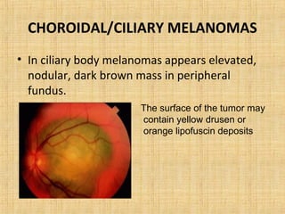 CHOROIDAL/CILIARY MELANOMAS
• In ciliary body melanomas appears elevated,
  nodular, dark brown mass in peripheral
  fundus.
                       The surface of the tumor may
                       contain yellow drusen or
                       orange lipofuscin deposits
 