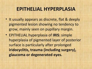 EPITHELIAL HYPERPLASIA
• It usually appears as discrete, flat & deeply
  pigmented lesion showing no tendency to
  grow, mainly seen on pupillary margin.
• EPITHELIAL hyperplasia of IRIS: simple
  hyperplasia of pigmented layer of posterior
  surface is particularly after prolonged
  iridocyclitis, trauma (including surgery),
  glaucoma or degenerated eyes.
 