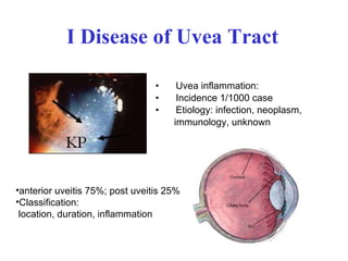 I Disease of Uvea Tract Uvea inflammation: Incidence 1/1000 case  Etiology: infection, neoplasm,  immunology, unknown anterior uveitis 75%; post uveitis 25% Classification: location, duration, inflammation 