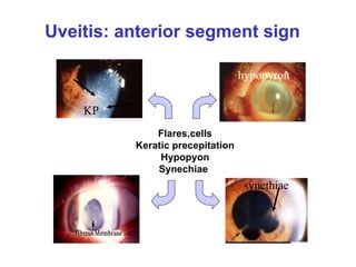 Uveitis: anterior segment sign hypopyron synethiae Flares,cells Keratic precepitation Hypopyon Synechiae   KP 