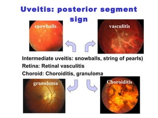 Uveitis: posterior segment sign hypopyron synethiae Intermediate uveitis: snowballs, string of pearls) Retina: Retinal vasculitis Choroid: Choroiditis, granuloma snowballs vasculitis Choroiditis granuloma 