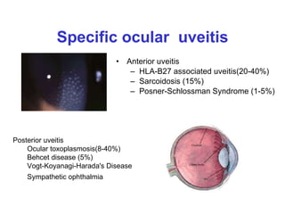 Specific ocular  uveitis Anterior uveitis HLA-B27 associated uveitis(20-40%) Sarcoidosis (15%)  Posner-Schlossman Syndrome  (1-5%) Posterior uveitis Ocular toxoplasmosis(8-40%) Behcet disease (5%) Vogt-Koyanagi-Harada's Disease Sympathetic ophthalmia  