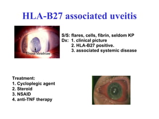 HLA-B27 associated uveitis S/S: flares, cells, fibrin, seldom KP Dx:  1. clinical picture  2. HLA-B27 positive. 3. associated   systemic disease Treatment:  1. Cycloplegic agent  2. Steroid 3. NSAID 4. anti-TNF therapy 