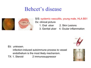 Behcet’s disease  S/S:  systemic vasculitis, young male, HLA B51   Dx: clinical picture 1. Oral  ulcer  2. Skin Lesions  3. Genital ulcer  4. Ocular inflammation  Eti:  unknown.  infection-induced autoimmune process to vessel  endothelium is the most likely mechanism.  TX:  1. Steroid  2 immunosuppressor 