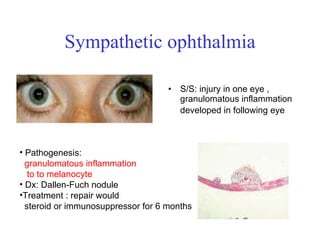 Sympathetic ophthalmia S/S: injury in one eye , granulomatous inflammation developed in following eye   Pathogenesis:  granulomatous inflammation  to to melanocyte   Dx: Dallen-Fuch nodule Treatment : repair would  steroid or immunosuppressor for 6 months 
