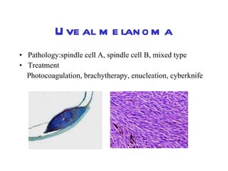 Uveal melanoma Pathology:spindle cell A, spindle cell B, mixed type Treatment  Photocoagulation, brachytherapy, enucleation, cyberknife  
