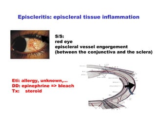 Episcleritis: episcleral tissue inflammation S/S:  red eye  episcleral vessel engorgement (between the conjunctiva and the sclera) Eti: allergy, unknown,… DD: epinephrine => bleach  Tx:  steroid 