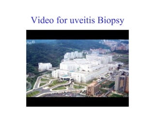 Video for uveitis Biopsy 