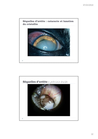 07/03/2010




S€quelles d’uv€ite : cataracte et luxation
du cristallin




S€quelles d’uv€ite : phtisis bulbi




                                                    12
 