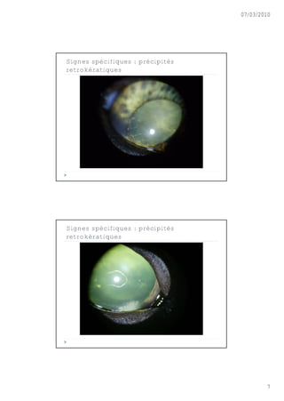 07/03/2010




Signes spécifiques : précipités
retrokératiques




Signes spécifiques : précipités
retrokératiques




                                          7
 