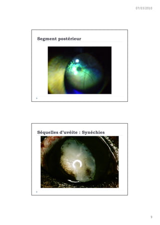 07/03/2010




Segment post€rieur




S€quelles d’uv€ite : Syn€chies




                                         9
 
