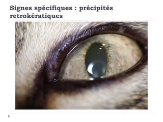 Signes spécifiques : précipités
retrokératiques
 