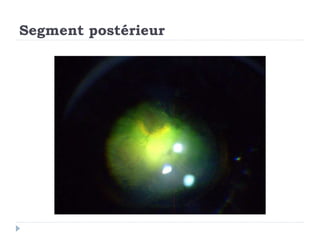 Segment postérieur
 