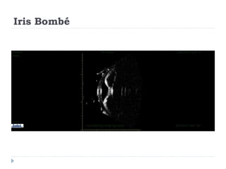Iris Bombé
 
