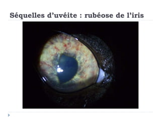 Séquelles d’uvéite : rubéose de l’iris
 