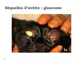 Séquelles d’uvéite : glaucome
 