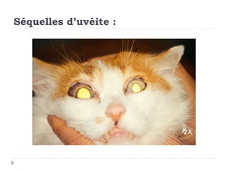 Séquelles d’uvéite :
 