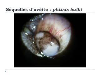 Séquelles d’uvéite : phtisis bulbi
 