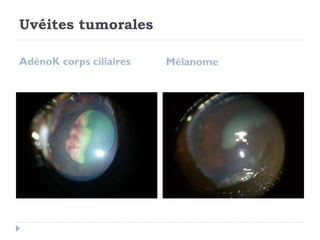 Uvéites tumorales
AdénoK corps ciliaires Mélanome
 