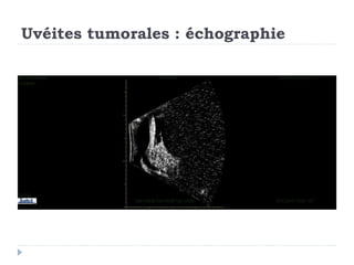 Uvéites tumorales : échographie
 