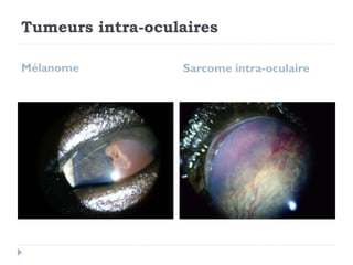 Tumeurs intra-oculaires
Mélanome Sarcome intra-oculaire
 