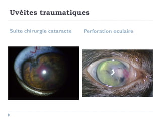 Uvéites traumatiques
Suite chirurgie cataracte Perforation oculaire
 
