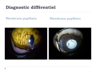 Diagnostic différentiel
Membrane pupillaire Membrane pupillaire
 