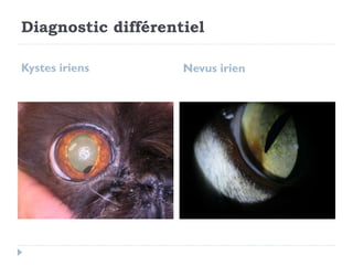Kystes iriens Nevus irien
Diagnostic différentiel
 