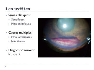 Les uvéites
 Signes cliniques
 Spécifiques
 Non spécifiques
 Causes multiples
 Non infectieuses
 Infectieuses
 Diagnostic souvent
frustrant
 