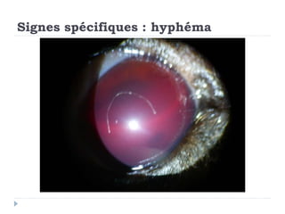 Signes spécifiques : hyphéma
 