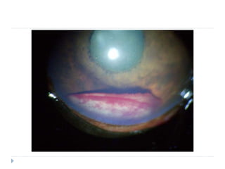 Specific sign : hypopion - Dog
 