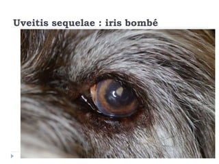 Uveitis sequelae : iris bombé
 