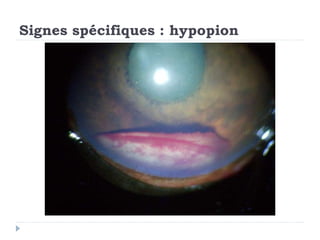 Signes spécifiques : hypopion
 