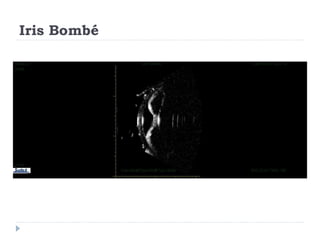 Iris Bombé
Echographic appearance of
Iris bombé – Dog
20 MHz probe
 