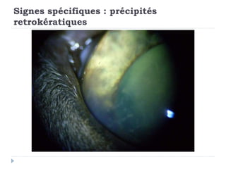Signes spécifiques : précipités
retrokératiques
 