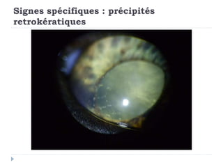 Signes spécifiques : précipités
retrokératiques
 
