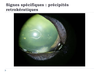 Signes spécifiques : précipités
retrokératiques
 