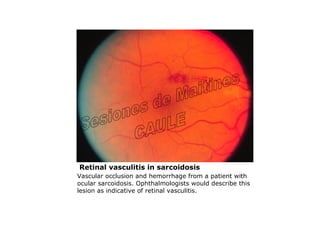 Retinal vasculitis in sarcoidosis
Vascular occlusion and hemorrhage from a patient with
ocular sarcoidosis. Ophthalmologists would describe this
lesion as indicative of retinal vasculitis.
 