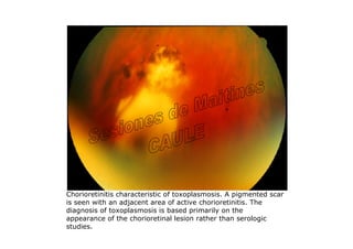 Chorioretinitis characteristic of toxoplasmosis. A pigmented scar
is seen with an adjacent area of active chorioretinitis. The
diagnosis of toxoplasmosis is based primarily on the
appearance of the chorioretinal lesion rather than serologic
studies.
 