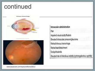 Uveitis Course Uveitis | PPTX