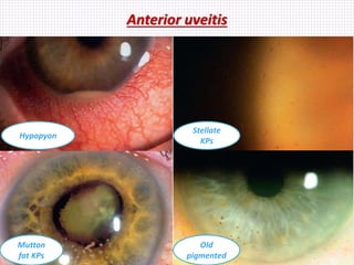 Anterior uveitis
Hypopyon
Stellate
KPs
Mutton
fat KPs
Old
pigmented
 