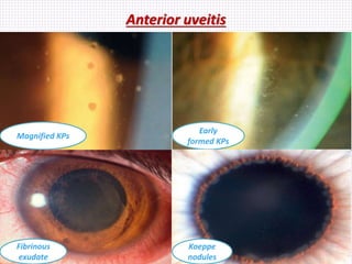 Anterior uveitis
Magnified KPs
Early
formed KPs
Fibrinous
exudate
Koeppe
nodules
 