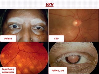VKH
Poliosis ERD
Poliosis, KPs
Sunset glow
appearance
 