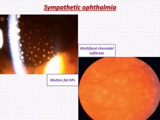 Sympathetic ophthalmia
Mutton fat KPs
Multifocal choroidal
infiltrate
 