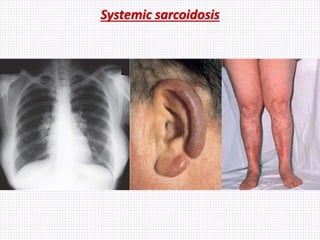 Systemic sarcoidosis
 